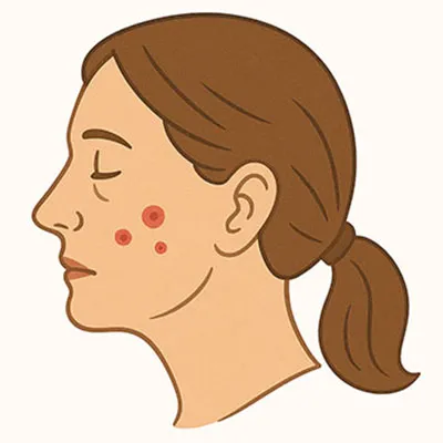 PIMPLES